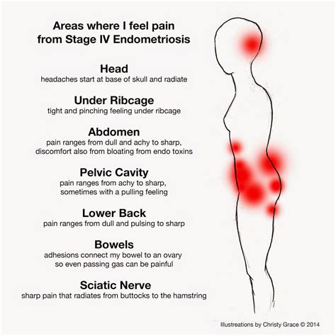 endometriosis symptoms tailbone pain
